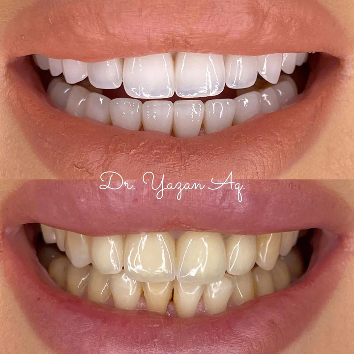 Caz Before & After realizat de Dr. Yazan Aq.