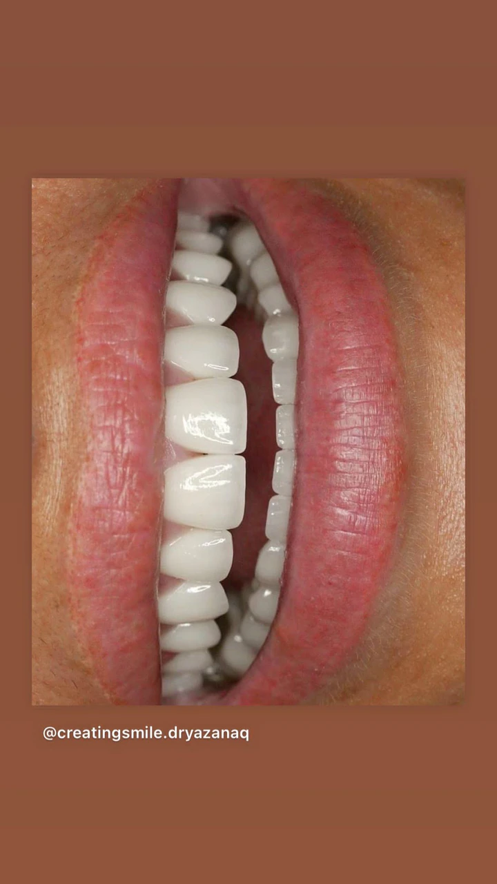 Caz Before & After realizat de Dr. Yazan Aq.