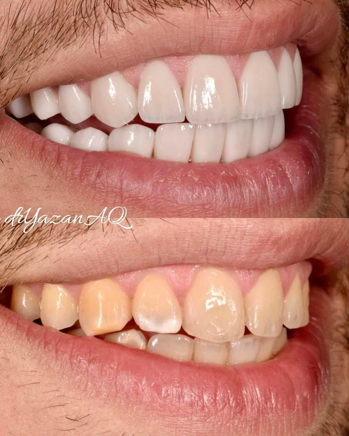 Caz Before & After realizat de Dr. Yazan Aq.