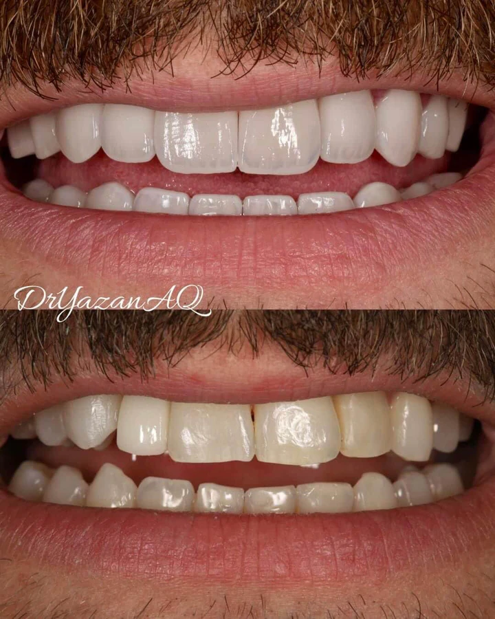 Caz Before & After realizat de Dr. Yazan Aq.