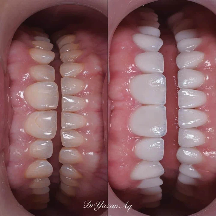 Caz Before & After realizat de Dr. Yazan Aq.