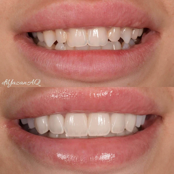 Caz Before & After realizat de Dr. Yazan Aq.