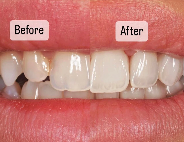 Caz Before & After realizat de Dr. Yazan Aq.