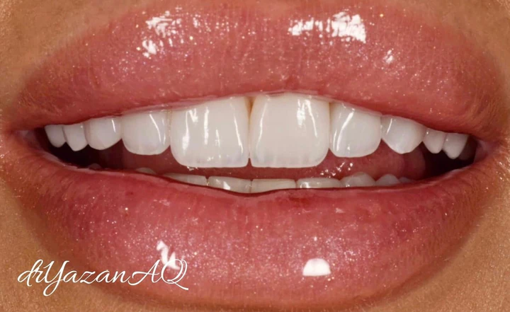 Caz Before & After realizat de Dr. Yazan Aq.