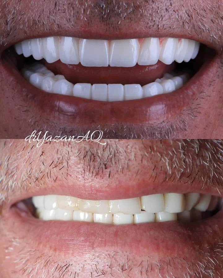 Caz Before & After realizat de Dr. Yazan Aq.