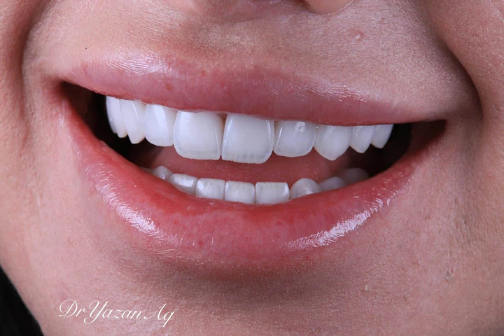 Caz Before & After realizat de Dr. Yazan Aq.