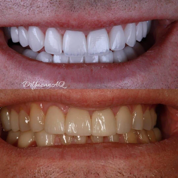 Caz Before & After realizat de Dr. Yazan Aq.