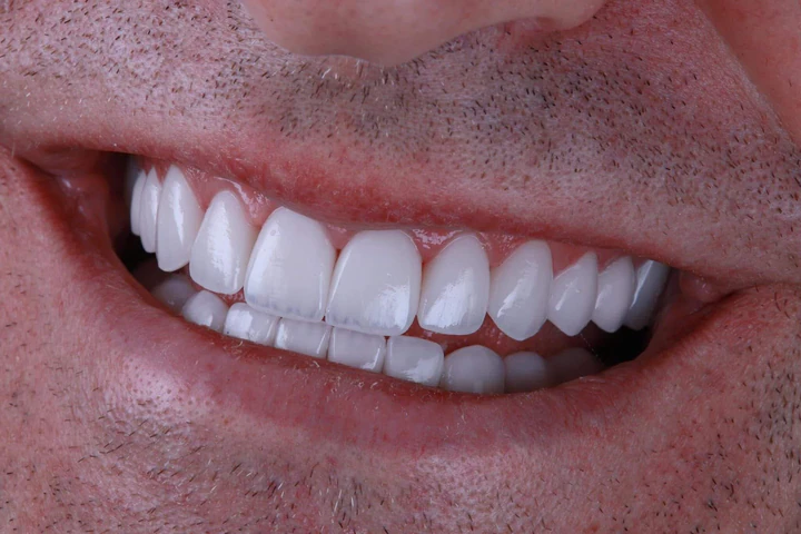 Caz Before & After realizat de Dr. Yazan Aq.