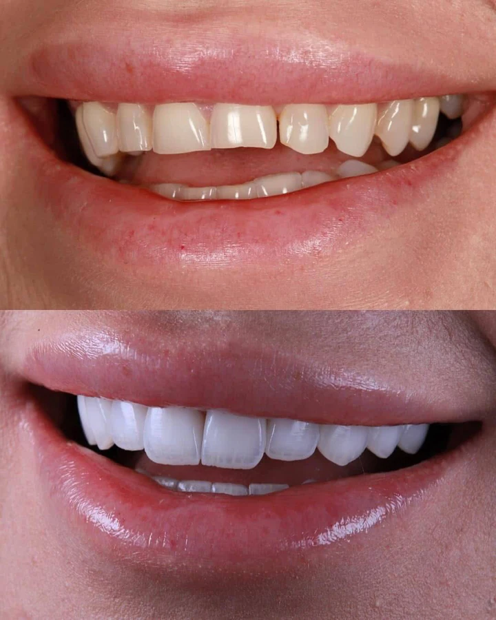Caz Before & After realizat de Dr. Yazan Aq.