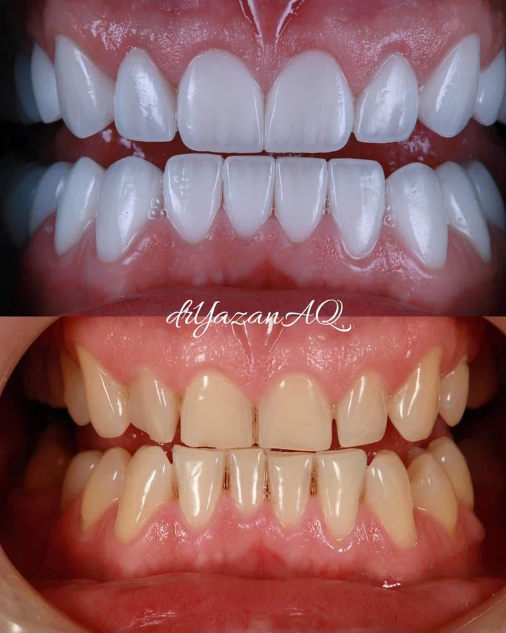 Caz Before & After realizat de Dr. Yazan Aq.