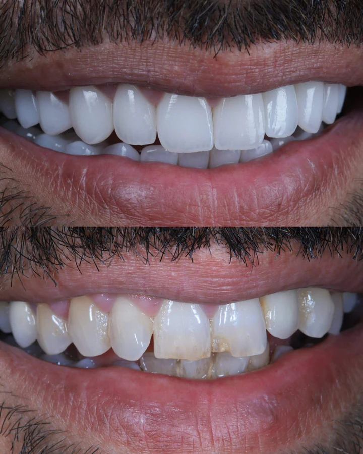 Caz Before & After realizat de Dr. Yazan Aq.