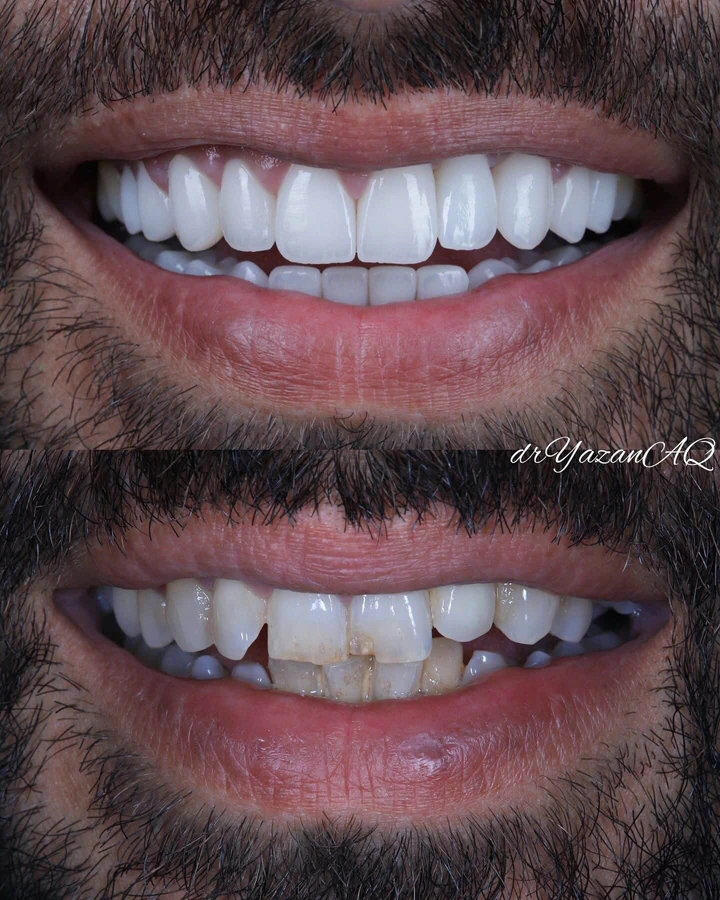 Caz Before & After realizat de Dr. Yazan Aq.