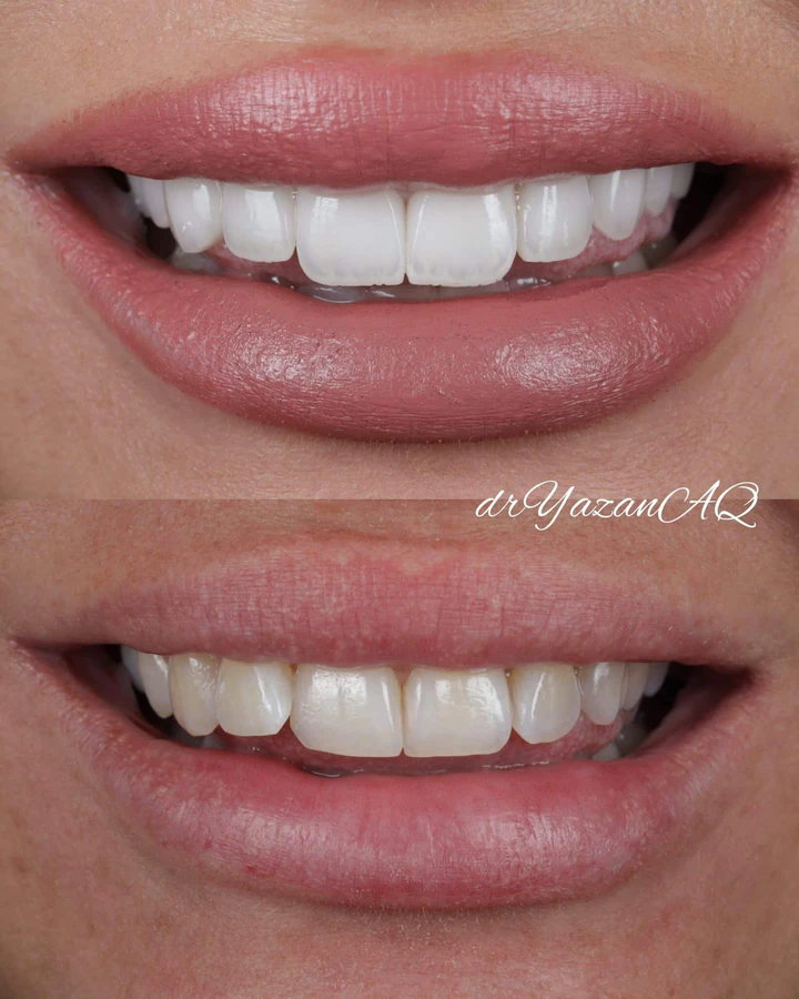 Caz Before & After realizat de Dr. Yazan Aq.