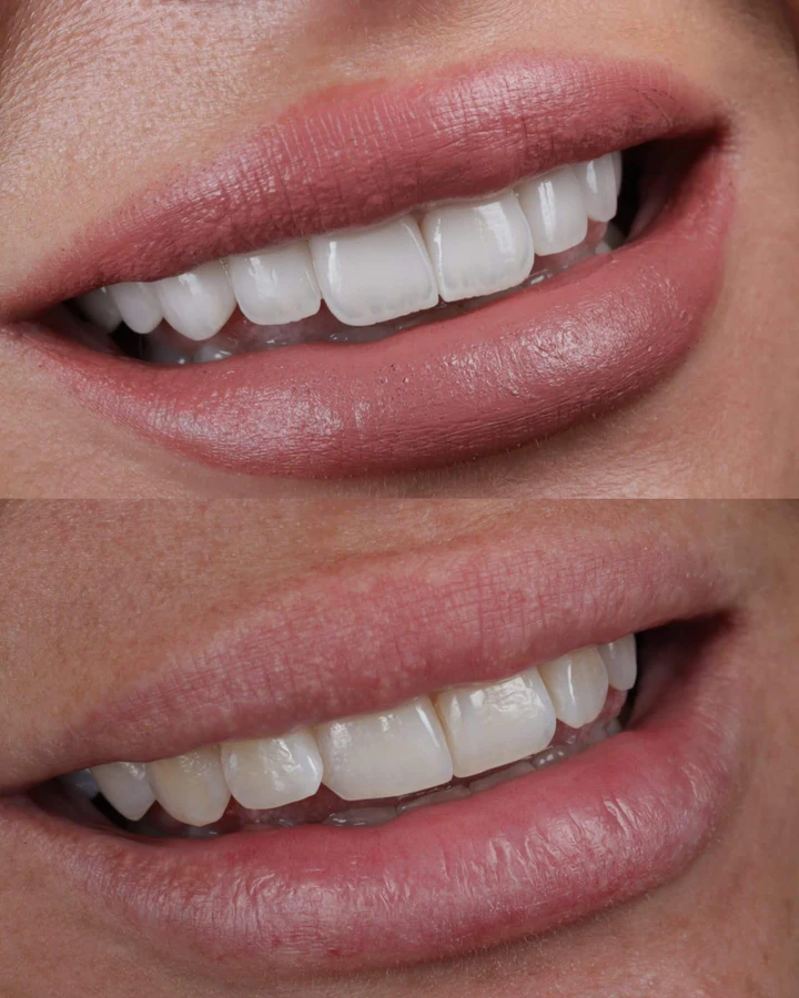 Caz Before & After realizat de Dr. Yazan Aq.