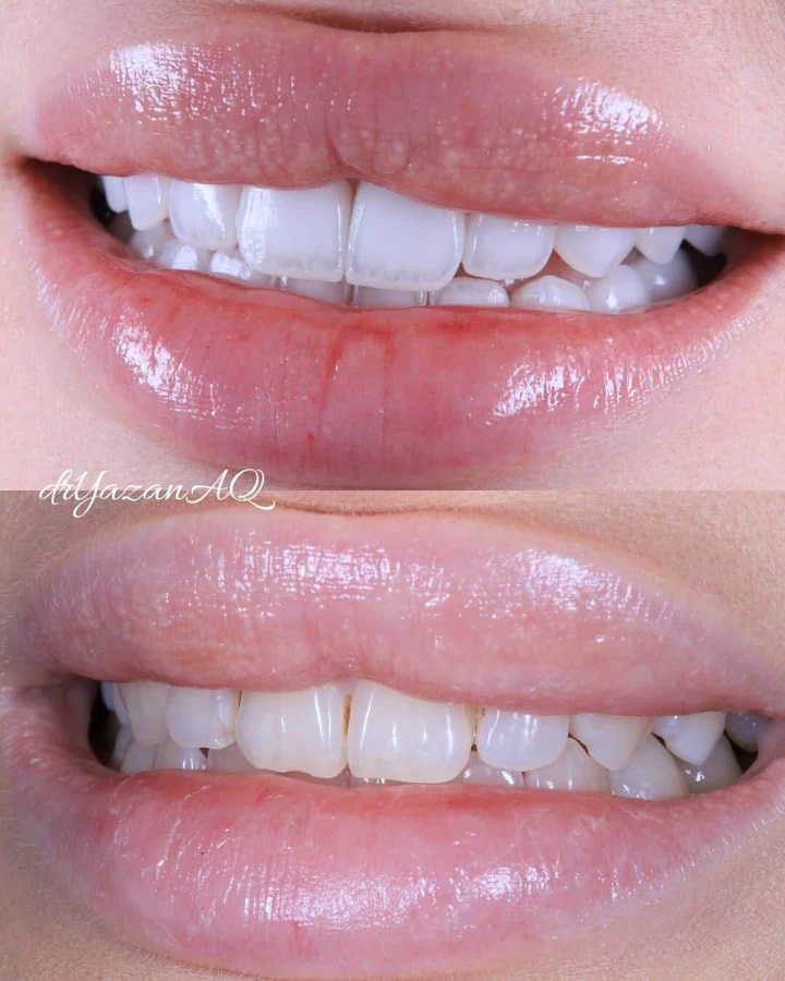 Caz Before & After realizat de Dr. Yazan Aq.
