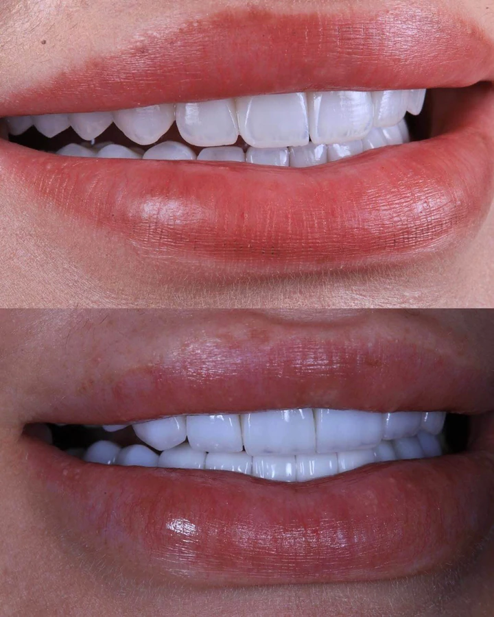 Caz Before & After realizat de Dr. Yazan Aq.