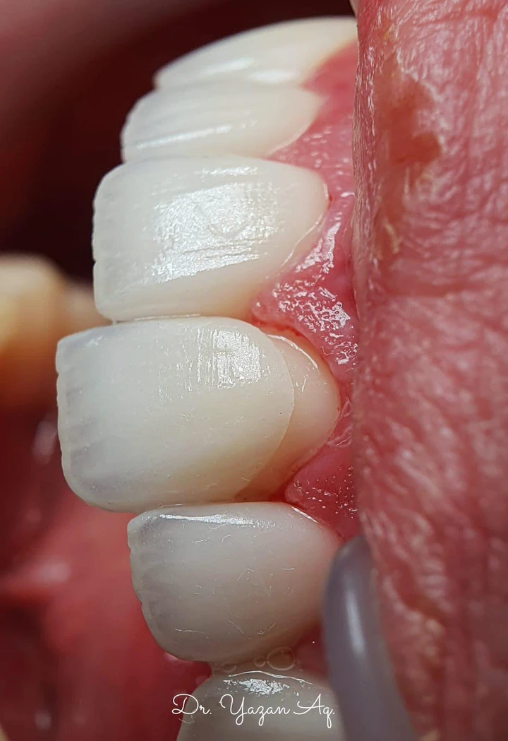 Caz Before & After realizat de Dr. Yazan Aq.