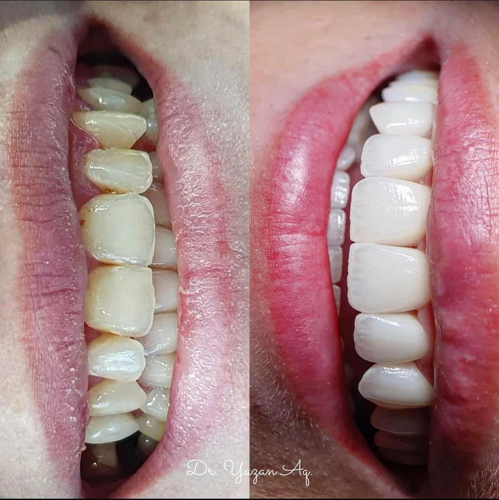 Caz Before & After realizat de Dr. Yazan Aq.