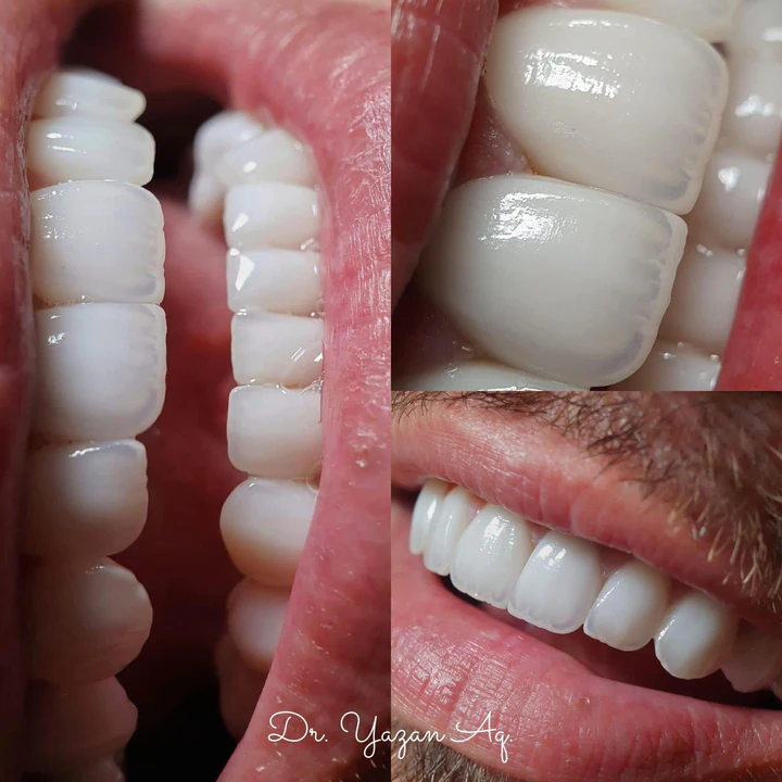 Caz Before & After realizat de Dr. Yazan Aq.