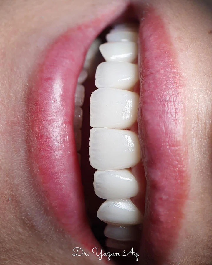 Caz Before & After realizat de Dr. Yazan Aq.