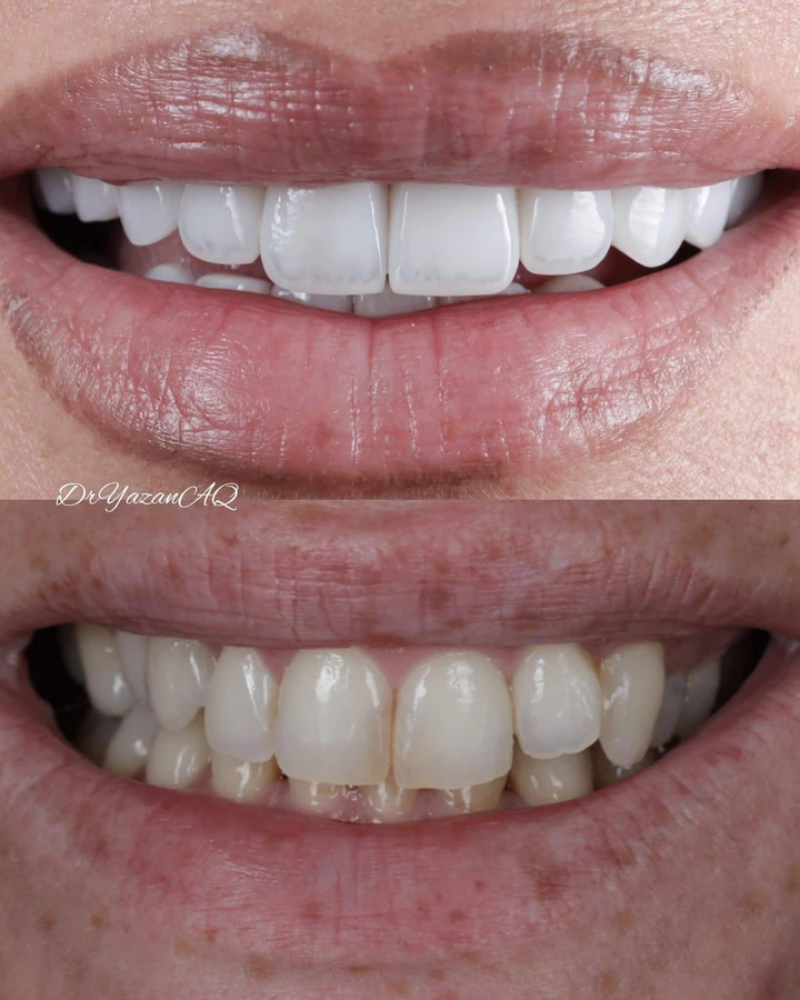 Caz Before & After realizat de Dr. Yazan Aq.