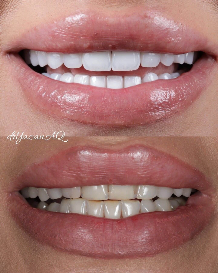 Caz Before & After realizat de Dr. Yazan Aq.
