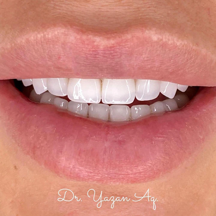 Caz Before & After realizat de Dr. Yazan Aq.