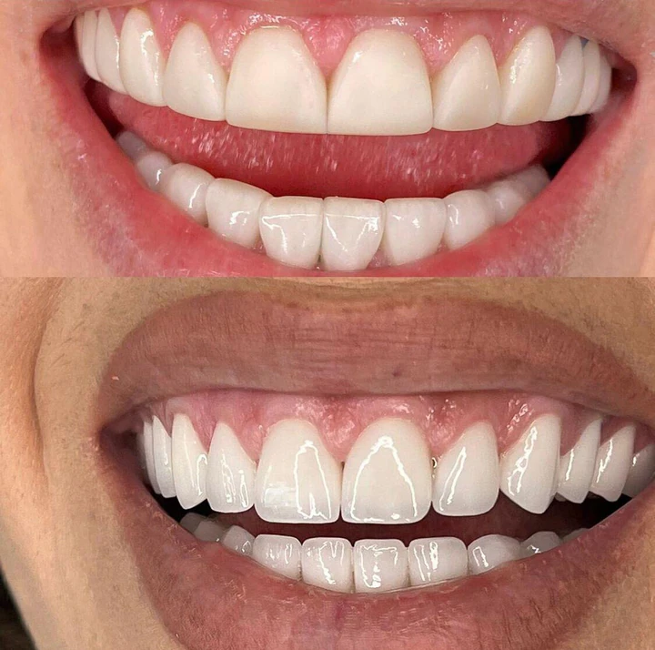 Caz Before & After realizat de Dr. Yazan Aq.