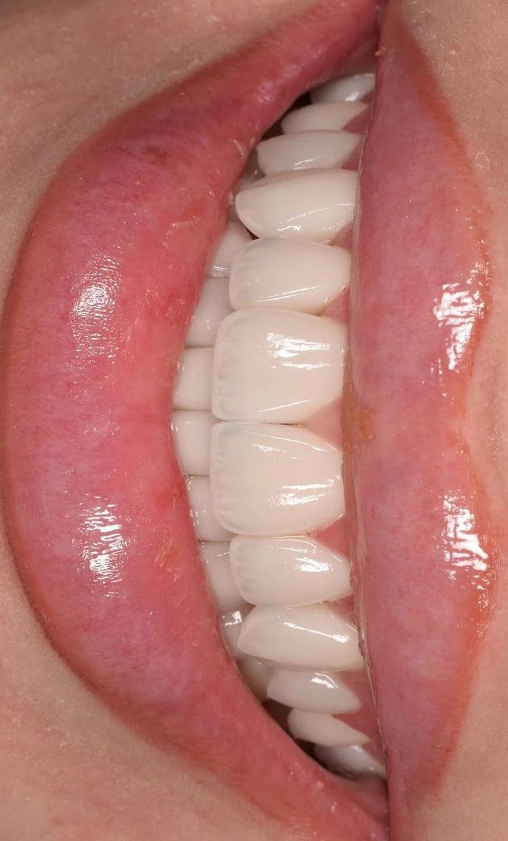 Caz Before & After realizat de Dr. Yazan Aq.