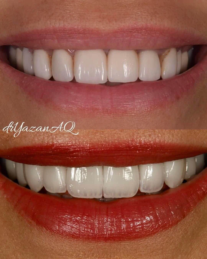Caz Before & After realizat de Dr. Yazan Aq.