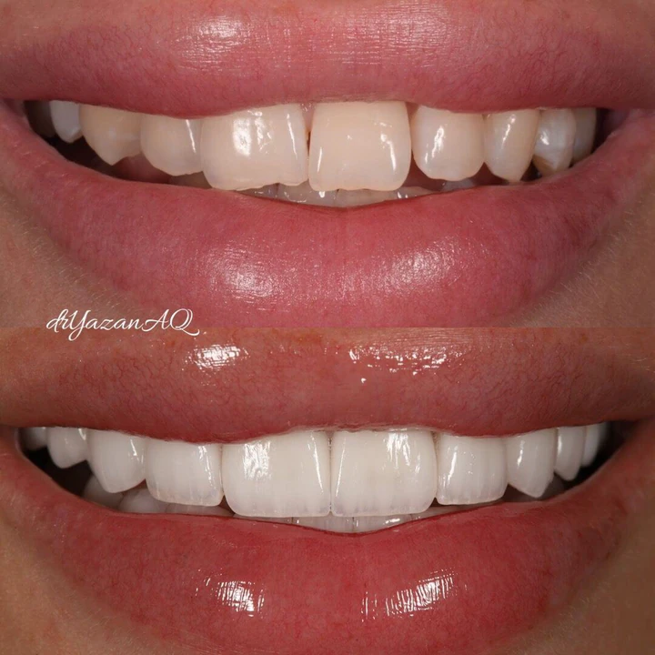 Caz Before & After realizat de Dr. Yazan Aq.