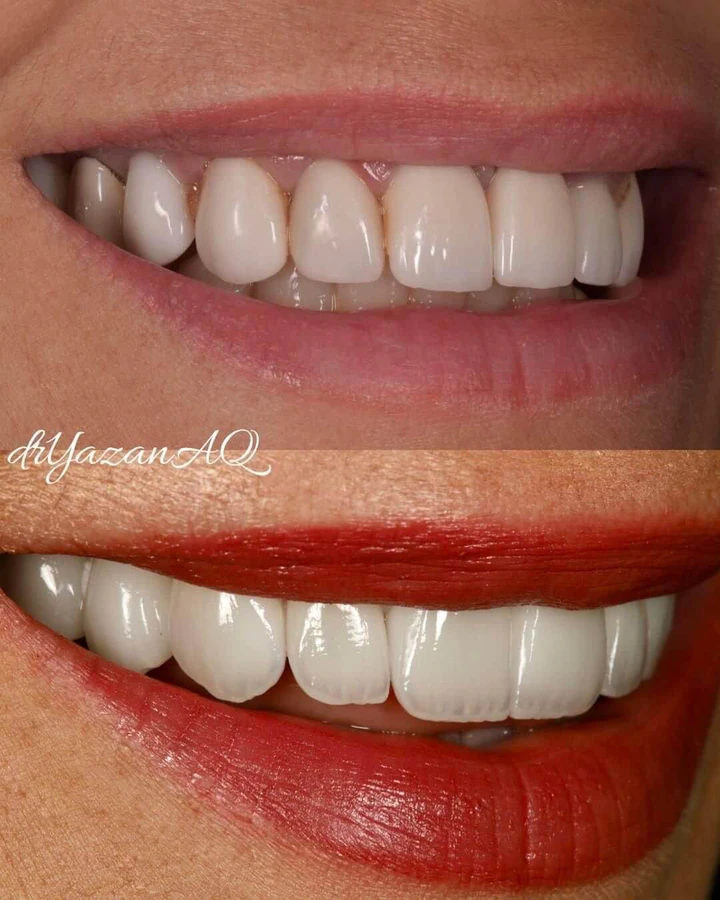 Caz Before & After realizat de Dr. Yazan Aq.