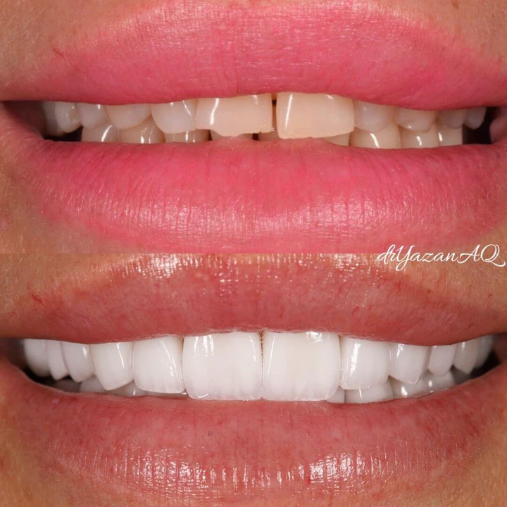 Caz Before & After realizat de Dr. Yazan Aq.