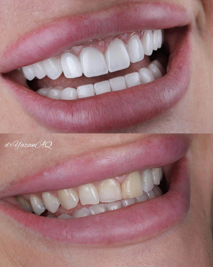 Caz Before & After realizat de Dr. Yazan Aq.
