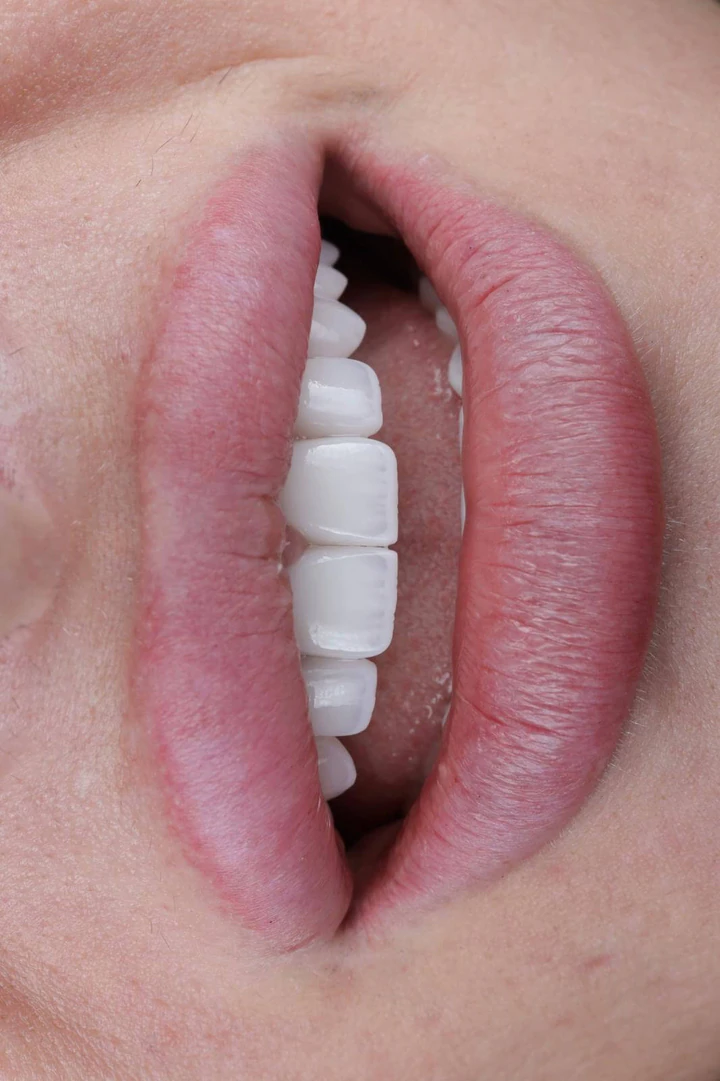Caz Before & After realizat de Dr. Yazan Aq.