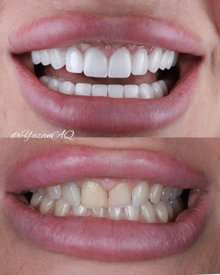 Caz Before & After realizat de Dr. Yazan Aq.
