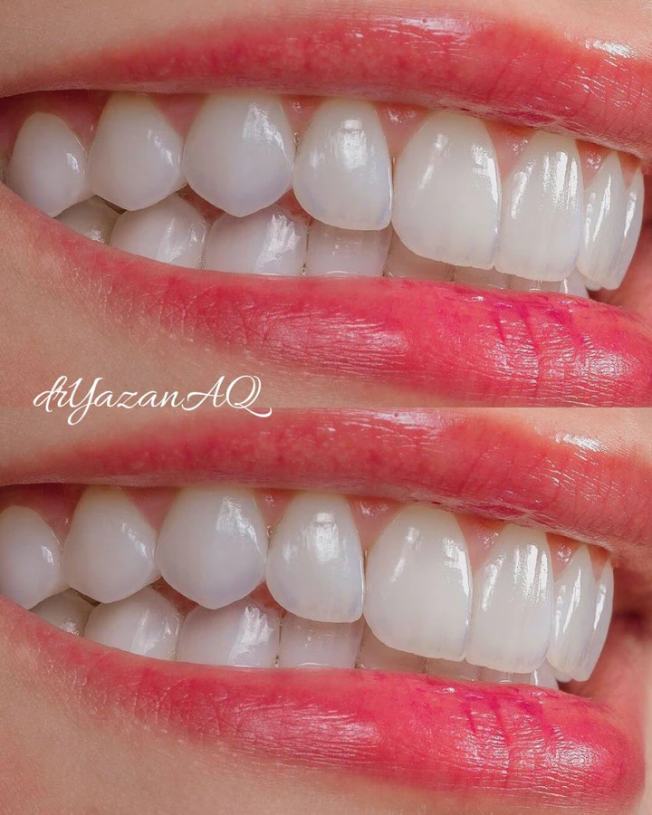Caz Before & After realizat de Dr. Yazan Aq.