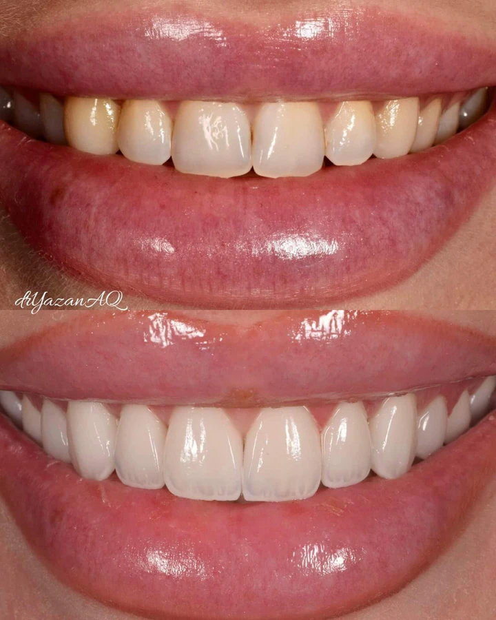 Caz Before & After realizat de Dr. Yazan Aq.