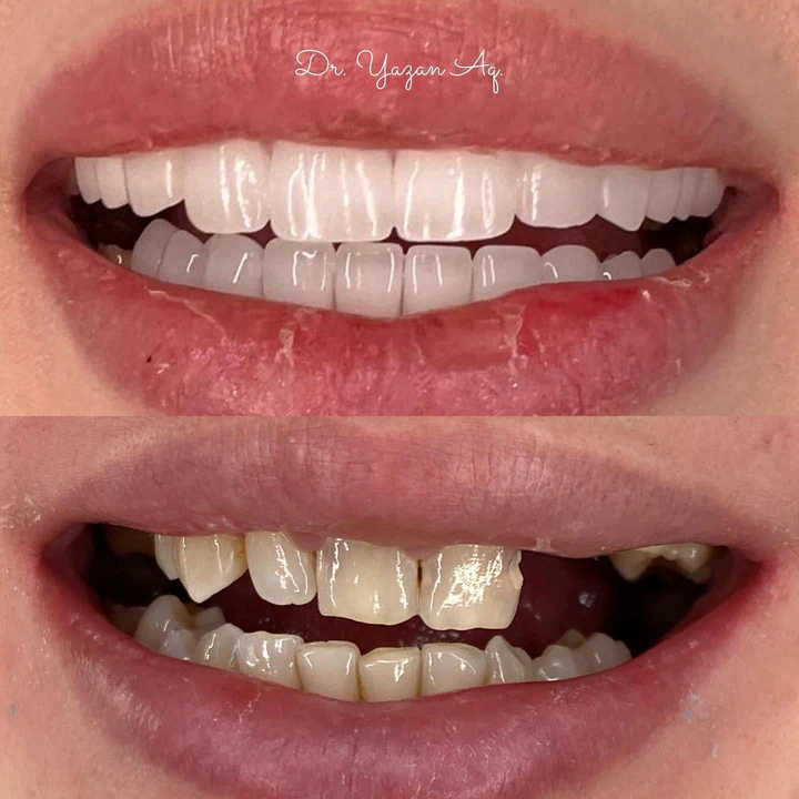 Caz Before & After realizat de Dr. Yazan Aq.