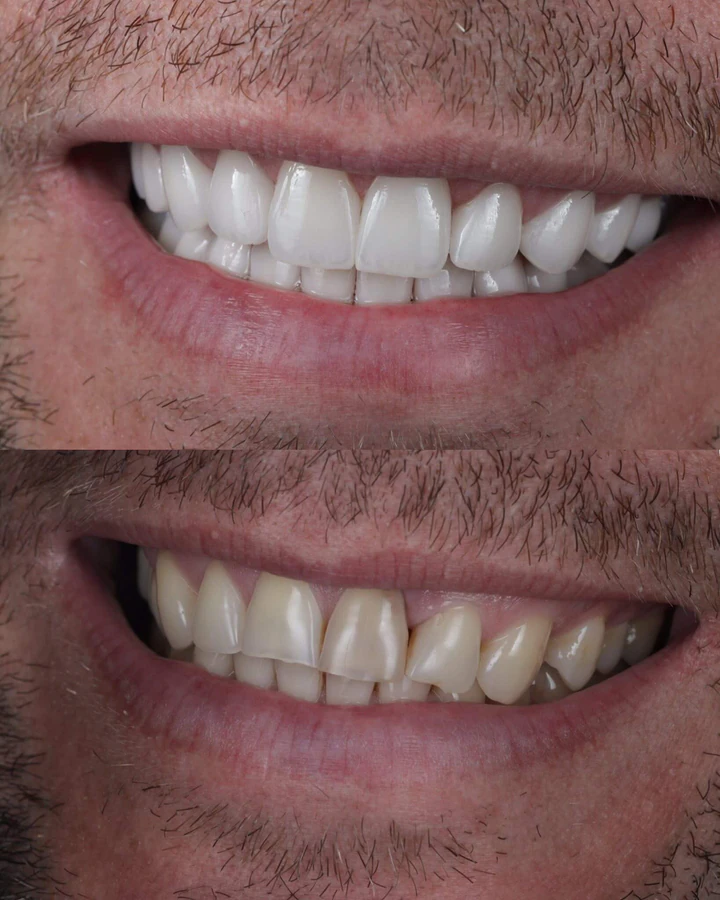 Caz Before & After realizat de Dr. Yazan Aq.