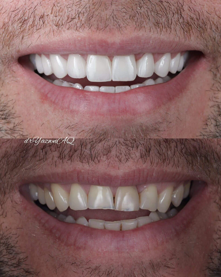 Caz Before & After realizat de Dr. Yazan Aq.