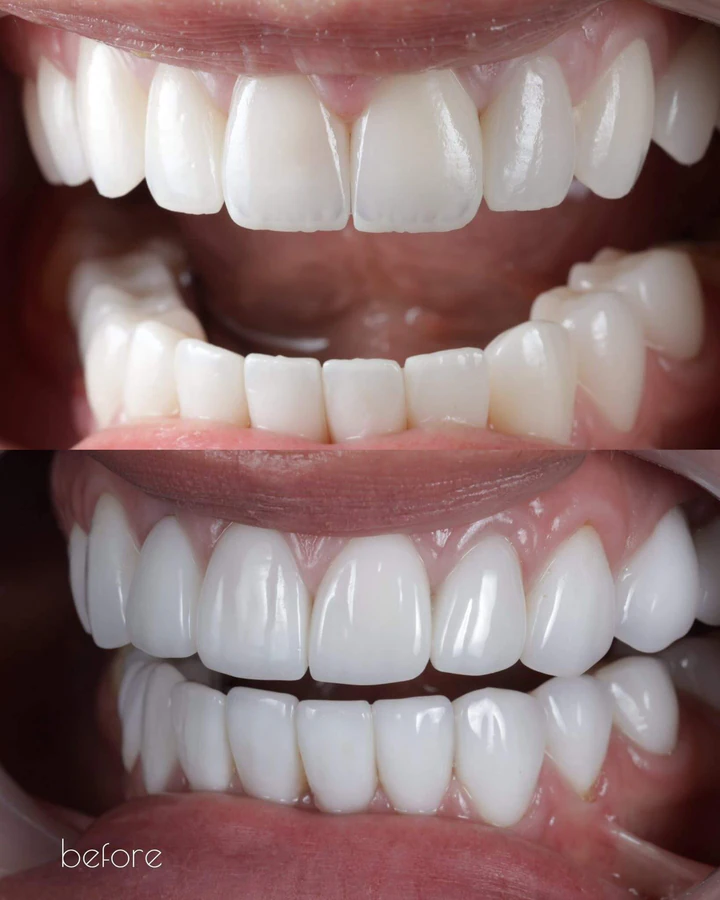 Caz Before & After realizat de Dr. Yazan Aq.
