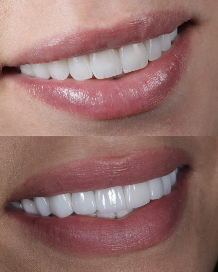 Caz Before & After realizat de Dr. Yazan Aq.