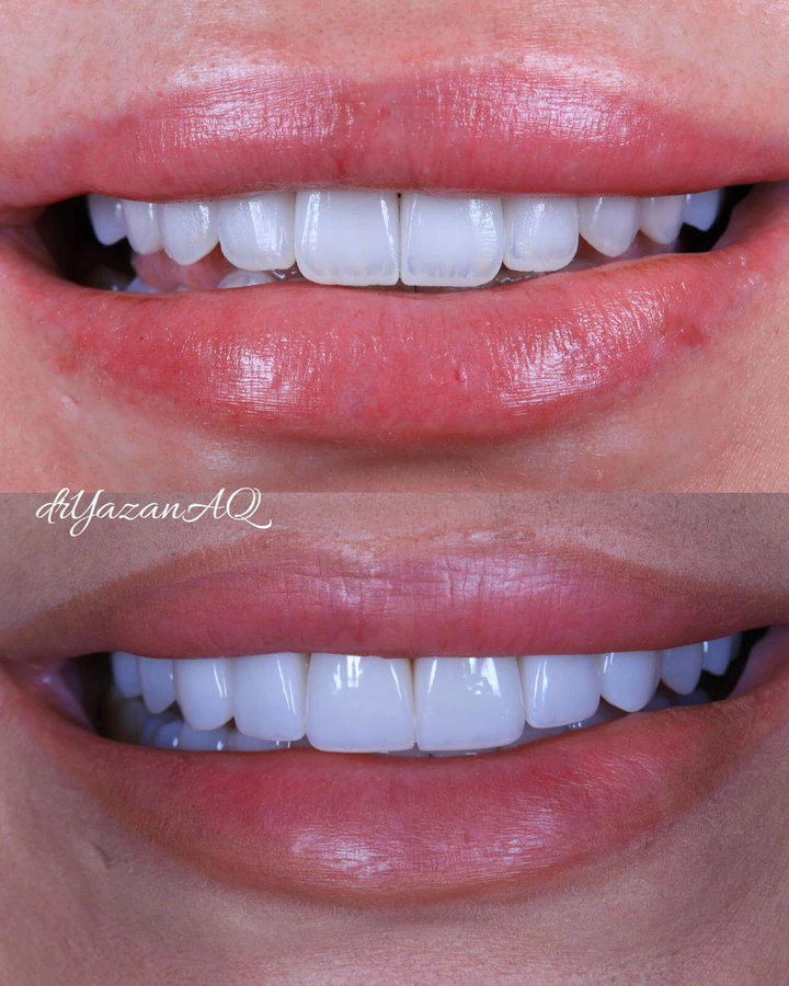 Caz Before & After realizat de Dr. Yazan Aq.