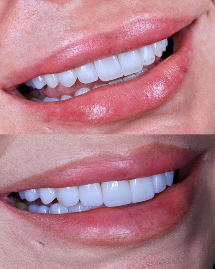 Caz Before & After realizat de Dr. Yazan Aq.