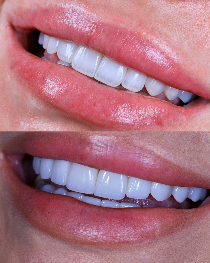 Caz Before & After realizat de Dr. Yazan Aq.