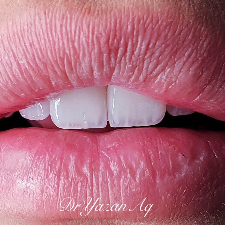 Caz Before & After realizat de Dr. Yazan Aq.
