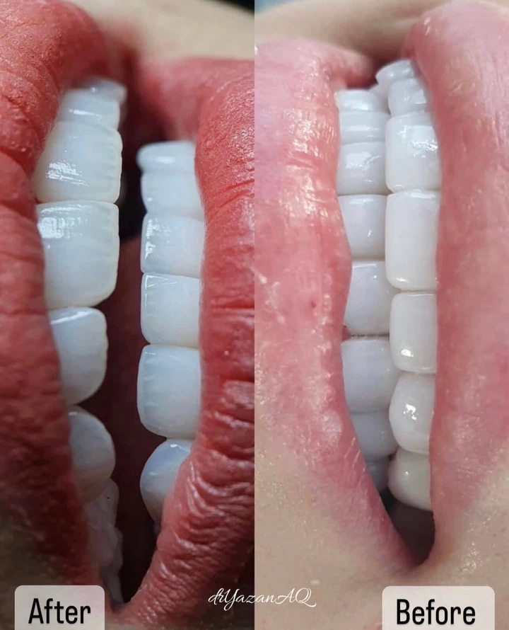 Caz Before & After realizat de Dr. Yazan Aq.