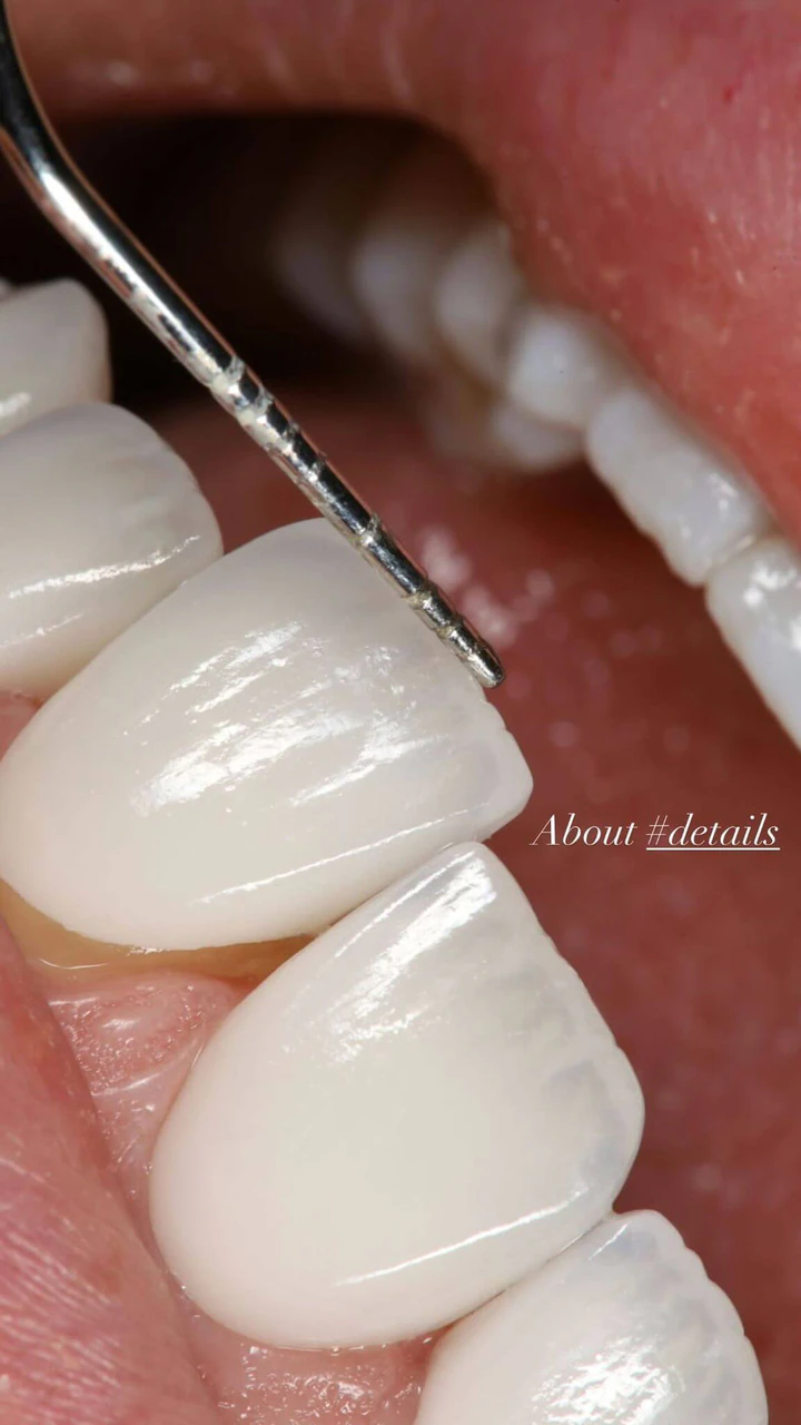 Caz Before & After realizat de Dr. Yazan Aq.