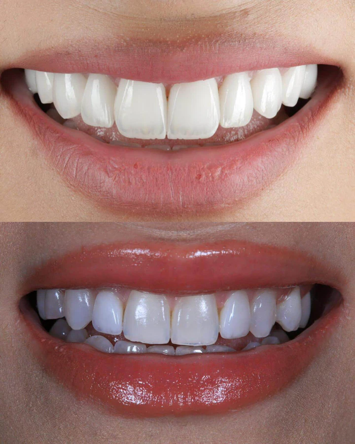 Caz Before & After realizat de Dr. Yazan Aq.